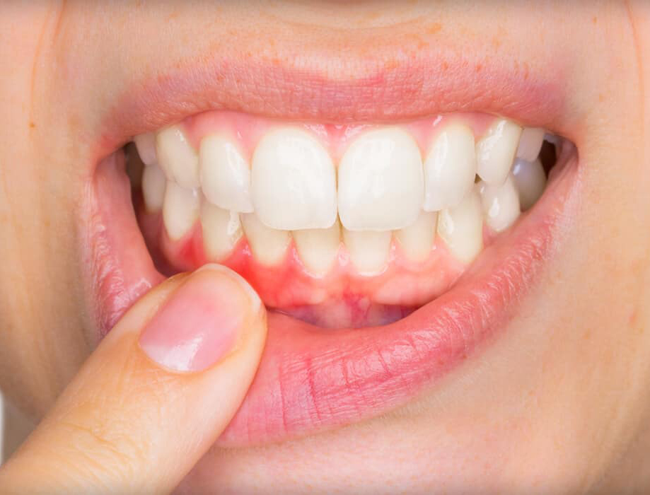 What are PERIODONTAL POCKETS and what can be done about them 2
