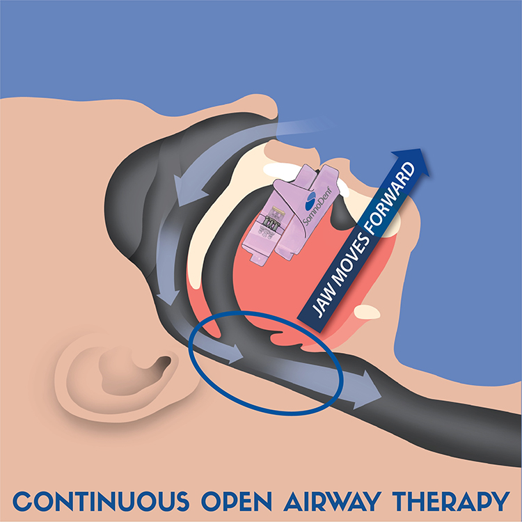 Your Dentist can help with Sleep Apnea 2