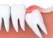 7 important points about the wisdom teeth removal process 1