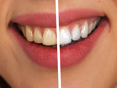 How to fix Yellow Teeth 2 copy