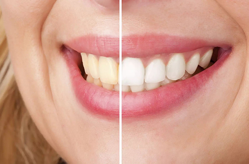 5 Ways To Maintain White Teeth Following A Whitening Procedure 5 Ways To Maintain White Teeth Following A Whitening Procedure