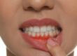 Important information about Gum disease 1