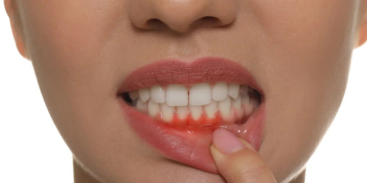 Important information about Gum disease 1 Important information about Gum disease 1