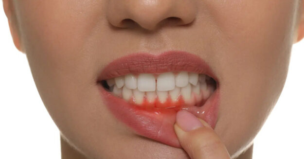 Important information about Gum disease 1 Important information about Gum disease 1