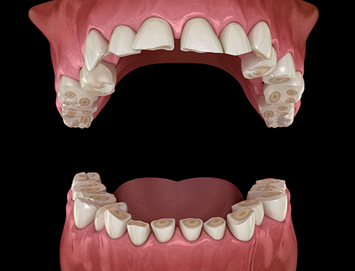 4 Symptoms of Bruxism & the TMJ and effects on teeth 1 4 Symptoms of Bruxism & the TMJ and effects on teeth 1