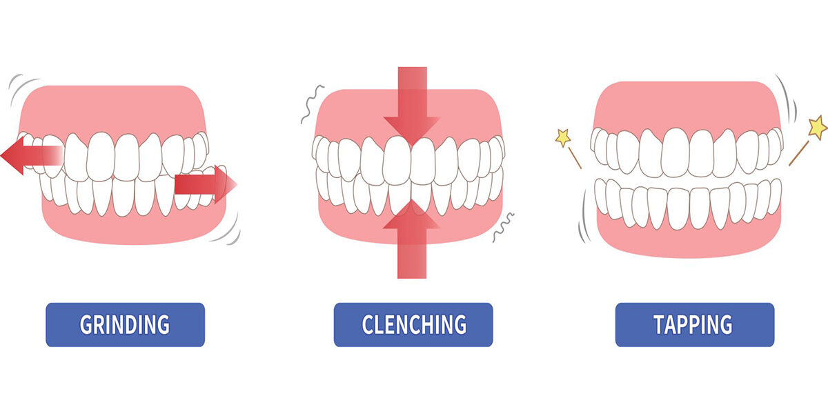 4 Symptoms of Bruxism & the TMJ and effects on teeth 2 copy 22