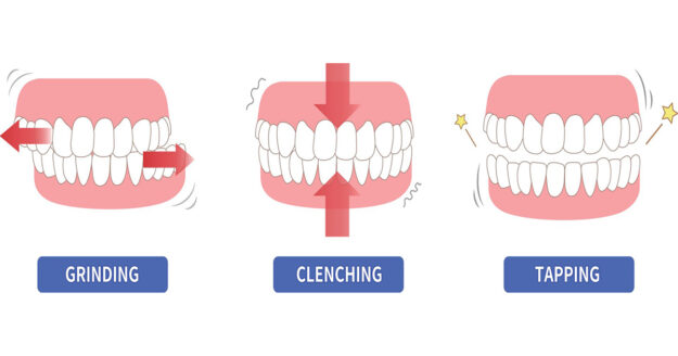 4 Symptoms of Bruxism & the TMJ and effects on teeth 2 copy 22