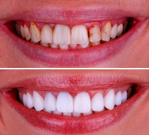 4 best reasons to get Dental Cosmetic Bonding 1