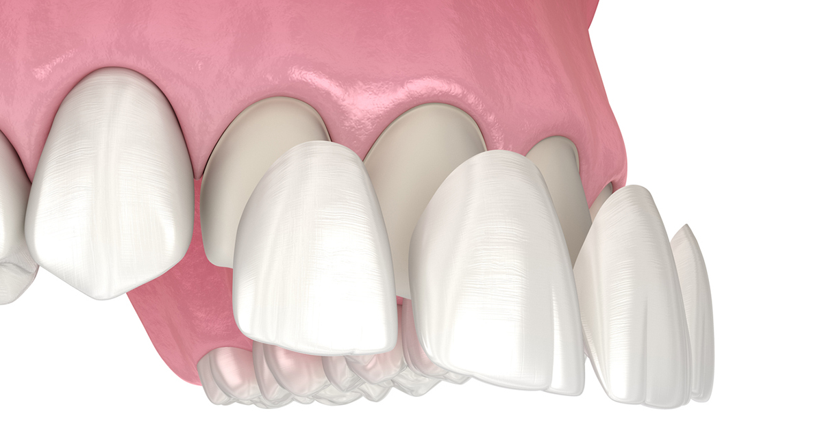 Veneer installation procedure over central incisor and lateral incisor. Medically accurate tooth 3D illustration