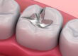 5 important reasons you should replace Dental Amalgam with resin composite fillings.