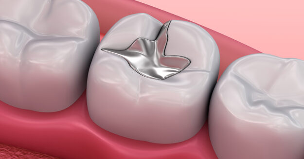5 important reasons you should replace Dental Amalgam with resin composite fillings.