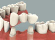 Important Info about Dental Bridges for teenagers and Young Adults 1 copy