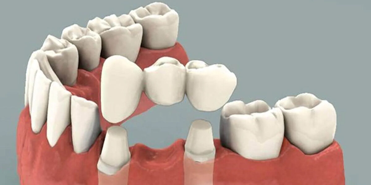 Important Info about Dental Bridges for teenagers and Young Adults 1 copy Important Info about Dental Bridges for teenagers and Young Adults 1 copy