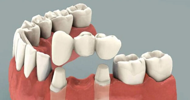 Important Info about Dental Bridges for teenagers and Young Adults 1 copy Important Info about Dental Bridges for teenagers and Young Adults 1 copy