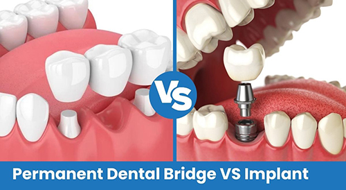Important Info about Dental Bridges for teenagers and Young Adults