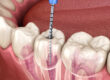 Important points about Dental Root Canal with a Crown
