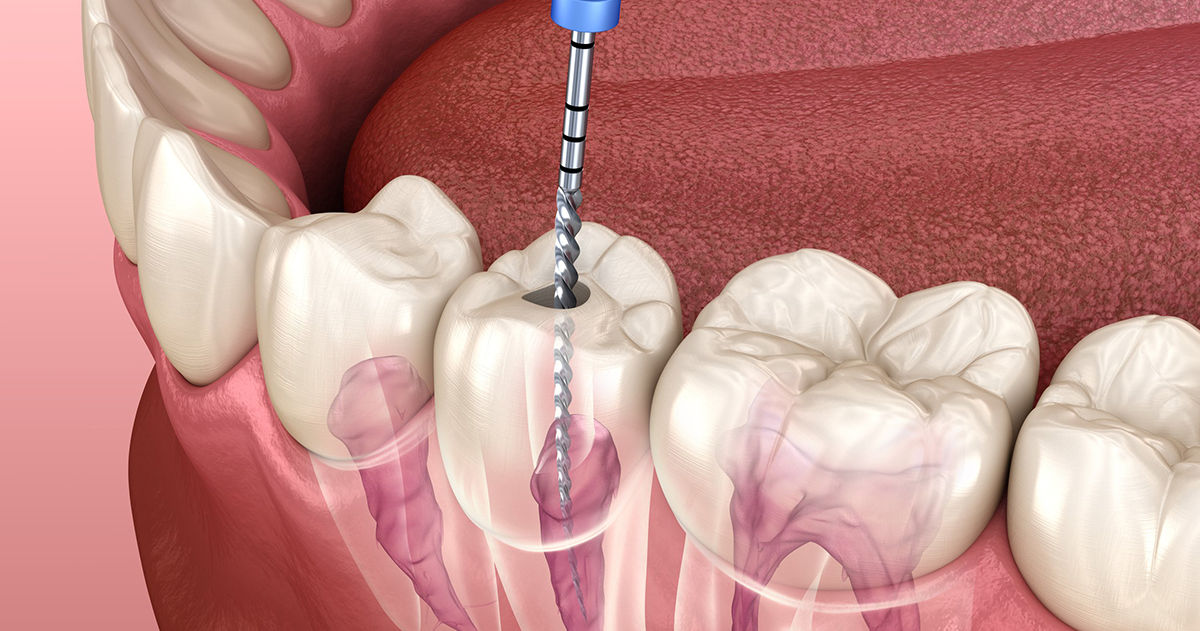 Important points about Dental Root Canal with a Crown Important points about Dental Root Canal with a Crown