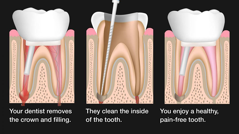 Important points about Dental Root Canal with a Crown 2