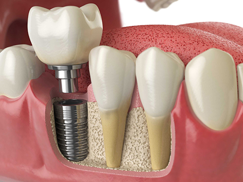 8 important pros and cons of dental implants 2