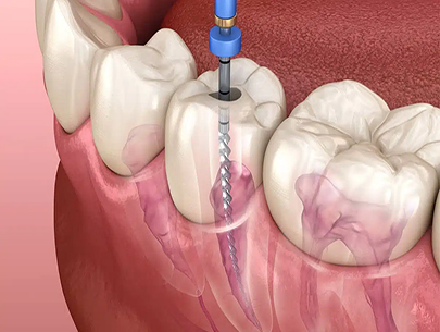 5 Important reasons to consider Dental Root Canal Treatment 1 copy