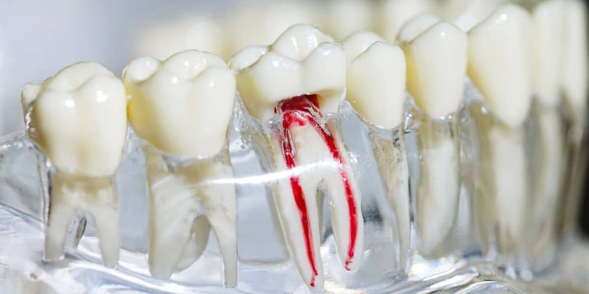 root canal treatment root canal treatment