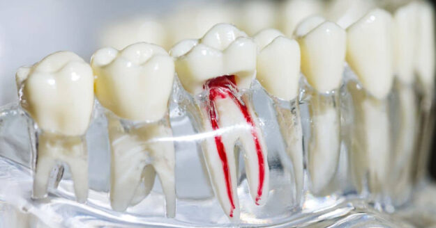 root canal treatment root canal treatment