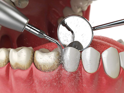 Does Dental Deep Cleaning Require Local Anesthesia 2 copy Does Dental Deep Cleaning Require Local Anesthesia 2 copy