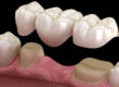 12 important points about Dental Bridges 1