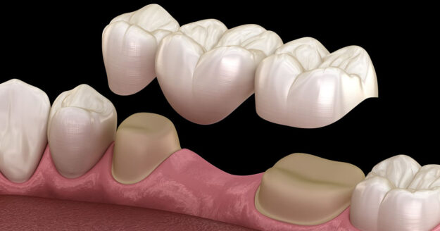 12 important points about Dental Bridges 1 12 important points about Dental Bridges 1