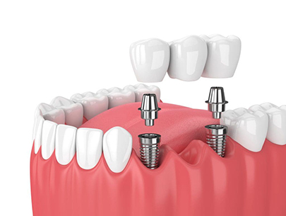 12 important points about Dental Bridges 2