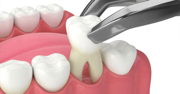 9 Important Points about How To Take Care Of Your Mouth After Dental Extractions 2 9 Important Points about How To Take Care Of Your Mouth After Dental Extractions 2