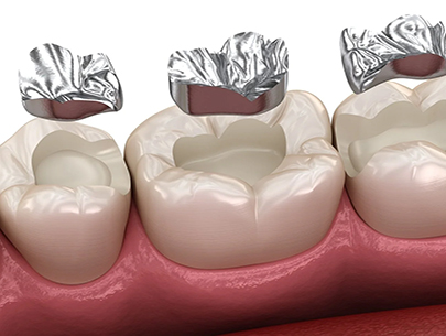8 impotrtant Reasons for and Benefits of Amalgam Removal 1 copy