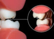 How your Dentist can help Prevent and treat Teeth Grinding