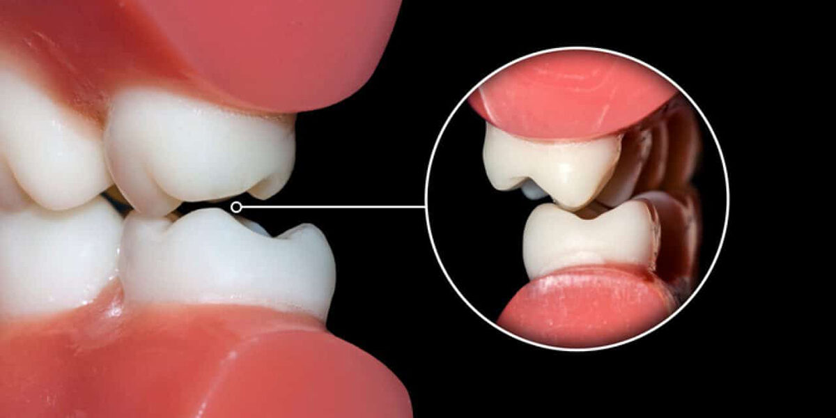 How your Dentist can help Prevent and treat Teeth Grinding How your Dentist can help Prevent and treat Teeth Grinding
