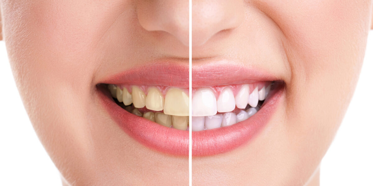 3 Important reasons why  Teeth Whitening is Best Done at the Dentist 3 Important reasons why Teeth Whitening is Best Done at the Dentist
