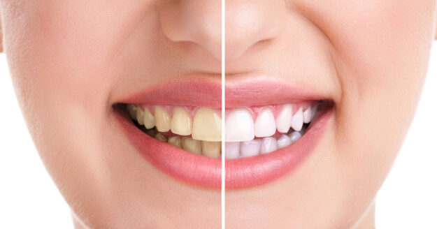 3 Important reasons why Teeth Whitening is Best Done at the Dentist