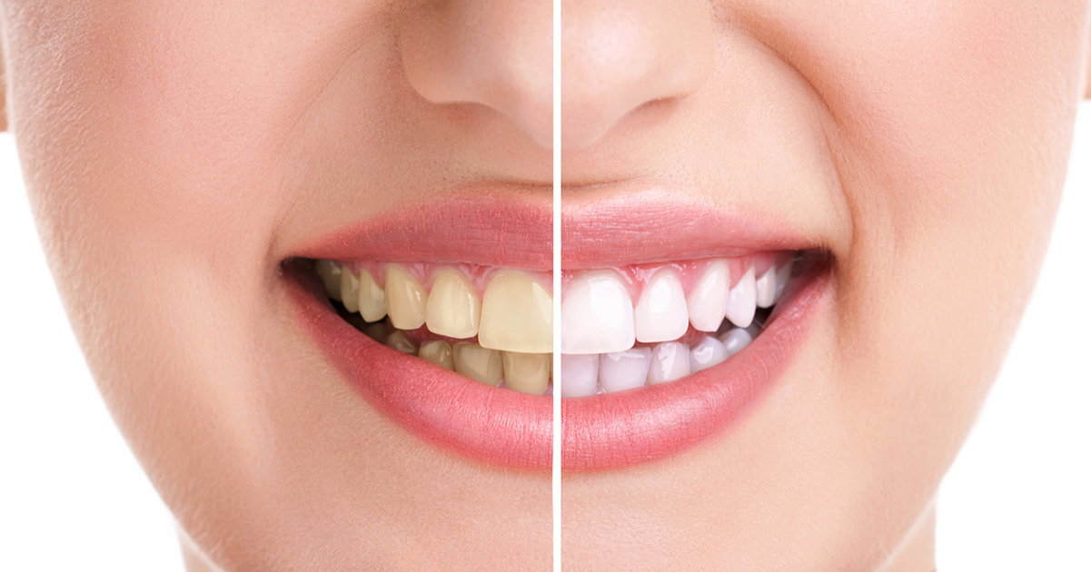3 Important reasons why Teeth Whitening is Best Done at the Dentist 3 Important reasons why Teeth Whitening is Best Done at the Dentist