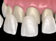 Important Points about How to Clean Porcelain Veneers 2