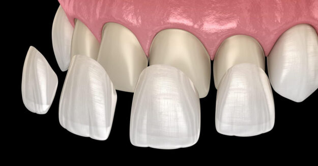 Important Points about How to Clean Porcelain Veneers 2