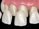 Important Points about How to Clean Porcelain Veneers 2