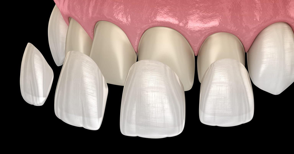 Important Points about How to Clean Porcelain Veneers 2 Important Points about How to Clean Porcelain Veneers 2