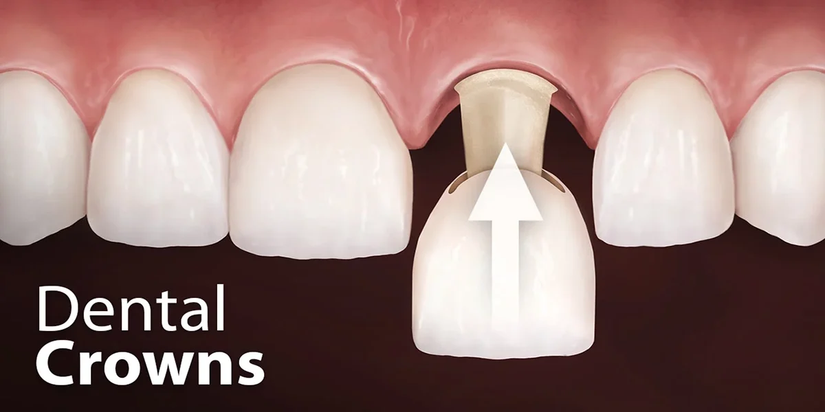 8 important points about How to take care of your dental crowns 2 8 important points about How to take care of your dental crowns 2
