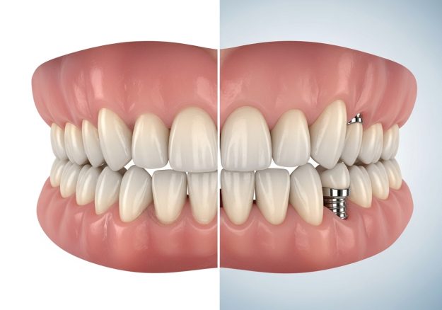 dental implants for false teeth