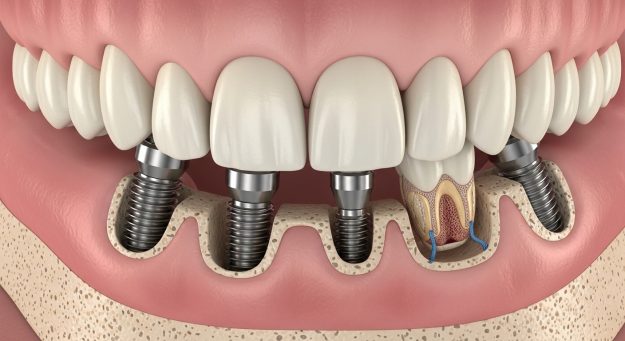 all on 4 dental implants - Oakstone Dental